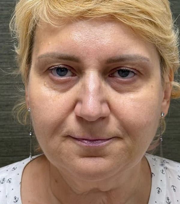 Комплексная коррекция: SMAS-лифтинг ULTRAFORMER MPT + ботулинотерапия — после