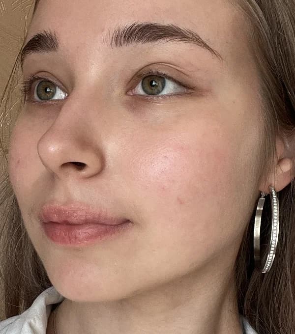 Лечение акне — после