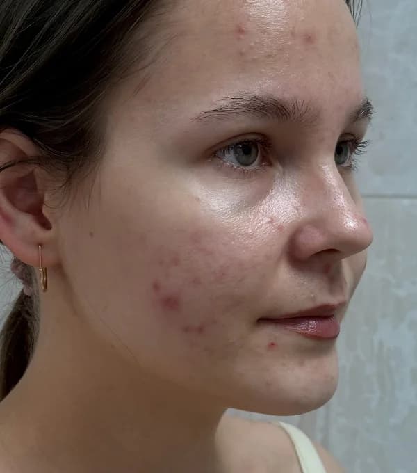 Лечение акне — до
