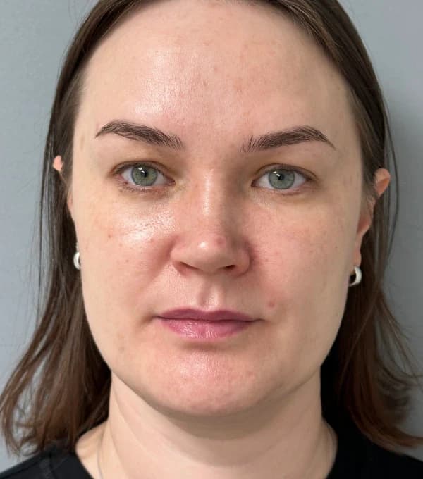 Комплексный подход: удаление невусов, фотоомоложение, биоревитализация REVI, ботулинотерапия Диспорт — после