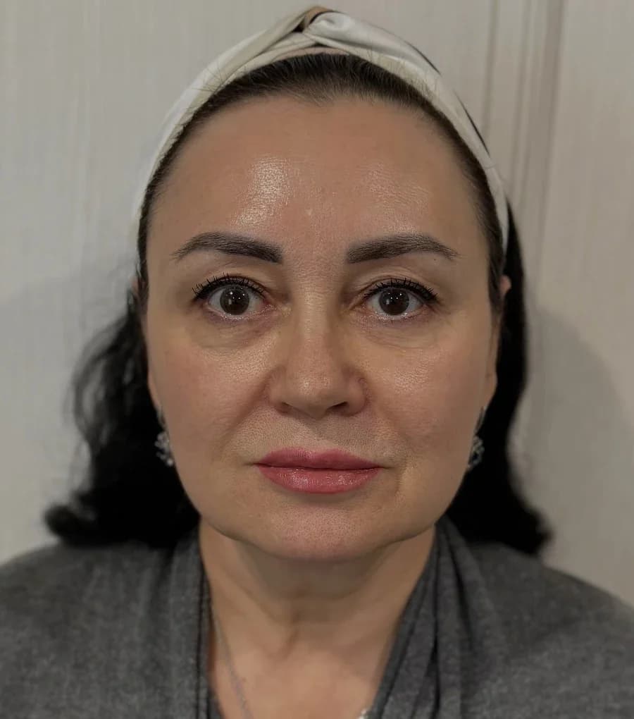 Комплексное омоложение: лазерное омоложение DEKA СО2 зона вокруг глаз, микроигольчатый RF лифтинг Sylfirm X, Radiesse, ботулинотерапия, инъекции ПДРН. Результат спустя 2 года. — после