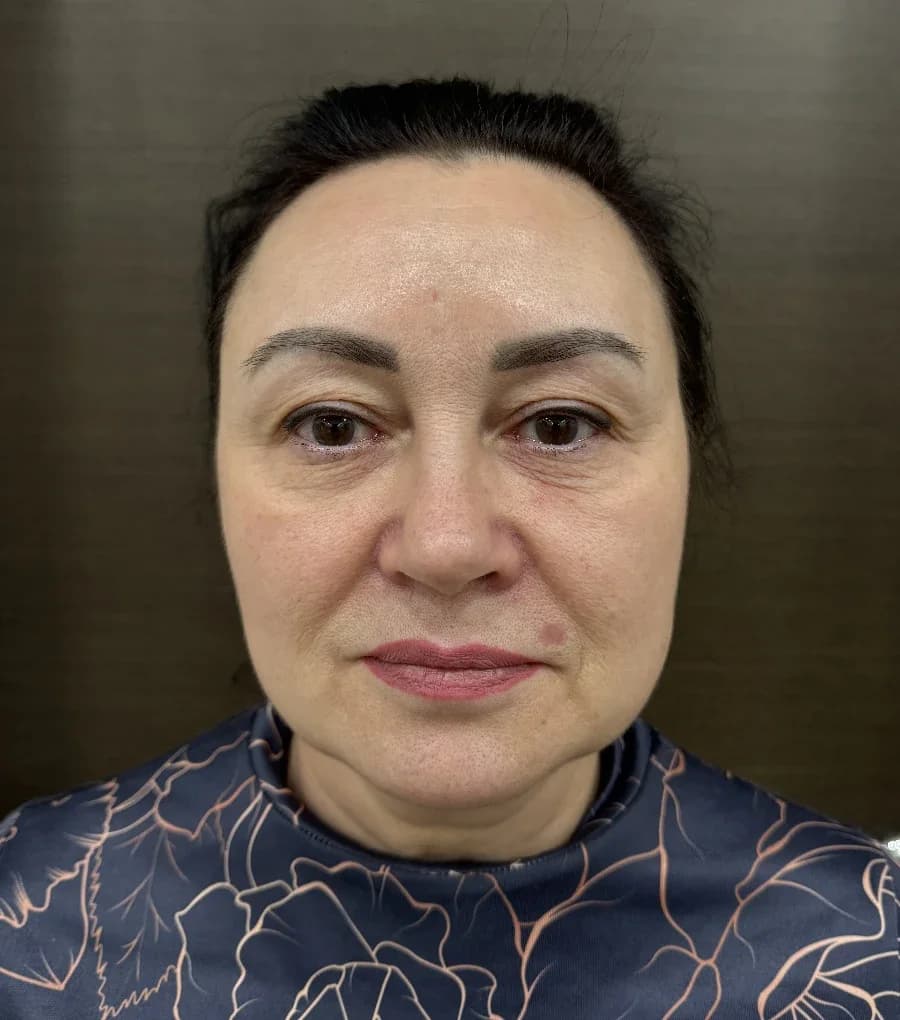 Комплексное омоложение: лазерное омоложение DEKA СО2 зона вокруг глаз, микроигольчатый RF лифтинг Sylfirm X, Radiesse, ботулинотерапия, инъекции ПДРН. Результат спустя 2 года. — до
